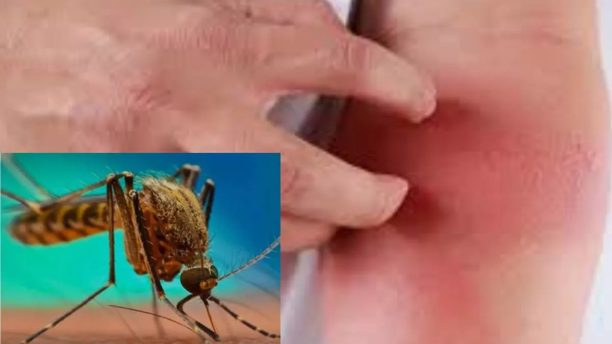 Filariasis Patients Will Be Identified Within A Day Through Antigen Test, 2.5 Lakh Kits Sought From Health Ministry